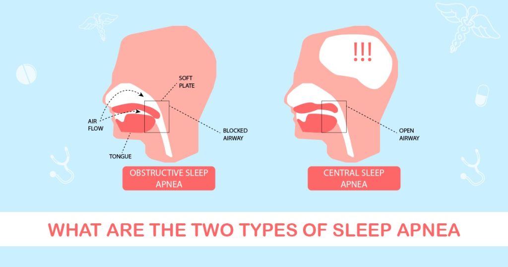 Two types of sleep apnea
